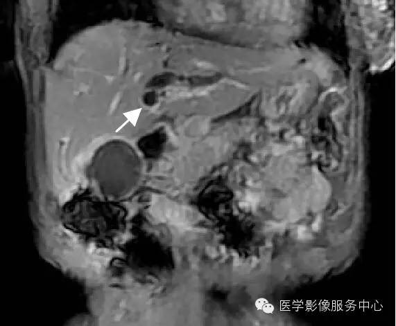 【病例】胆管癌1例MR影像表现 【病例】胆管癌1例MR影像表现