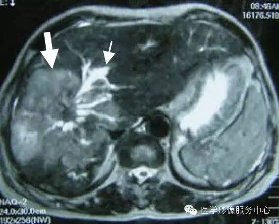 【病例】胆管癌1例MR影像表现 【病例】胆管癌1例MR影像表现