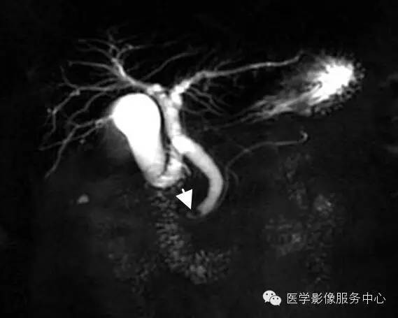 【病例】胆管癌1例MR影像表现 【病例】胆管癌1例MR影像表现