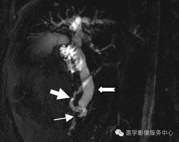 【病例】胆管癌1例MR影像表现 【病例】胆管癌1例MR影像表现