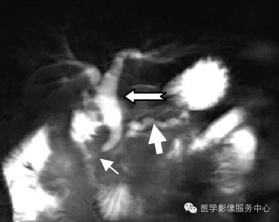 【病例】胆管癌1例MR影像表现 【病例】胆管癌1例MR影像表现