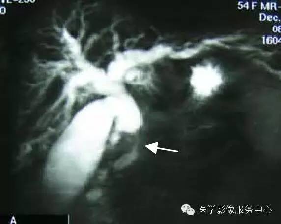 【病例】胆管癌1例MR影像表现 【病例】胆管癌1例MR影像表现