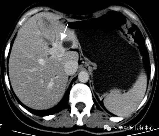 【病例】胆管癌1例MR影像表现 【病例】胆管癌1例MR影像表现