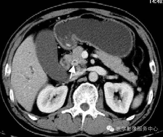 【病例】胆管癌1例MR影像表现 【病例】胆管癌1例MR影像表现