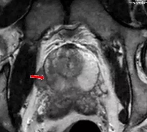 【病例】前列腺腺癌1例MR影像诊断要点