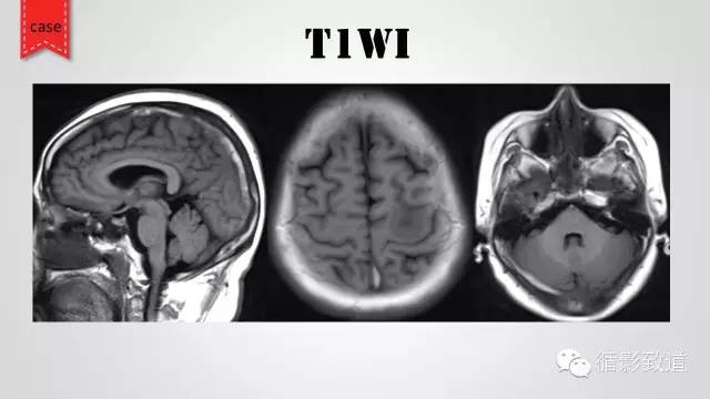 【病例】颅内静脉窦血栓形成1例CT及MR影像表现