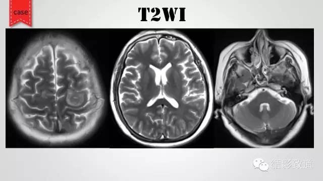 【病例】颅内静脉窦血栓形成1例CT及MR影像表现