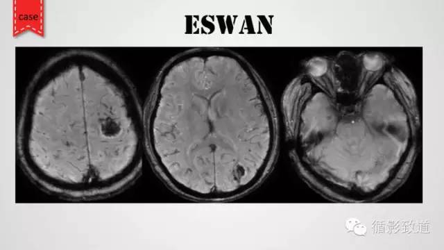 【病例】颅内静脉窦血栓形成1例CT及MR影像表现