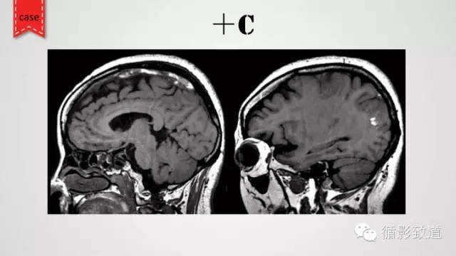 【病例】颅内静脉窦血栓形成1例CT及MR影像表现