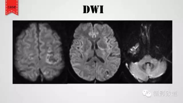 【病例】颅内静脉窦血栓形成1例CT及MR影像表现