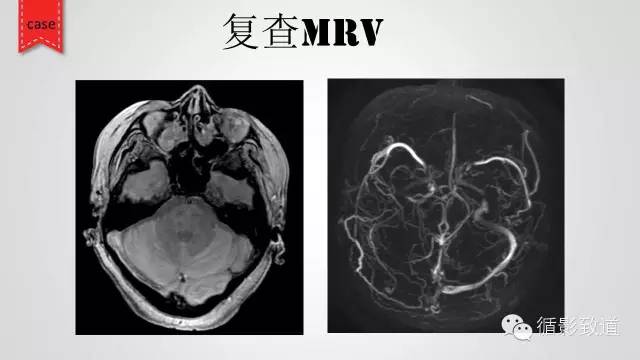 【病例】颅内静脉窦血栓形成1例CT及MR影像表现