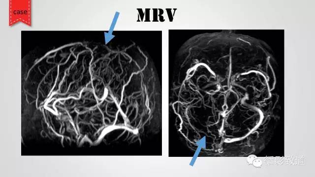 【病例】颅内静脉窦血栓形成1例CT及MR影像表现