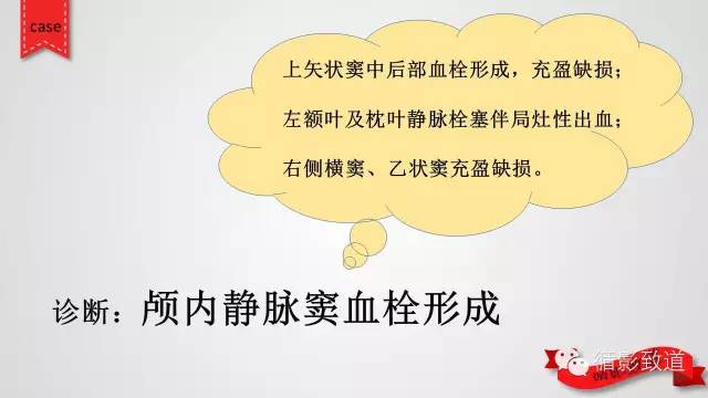 【病例】颅内静脉窦血栓形成1例CT及MR影像表现