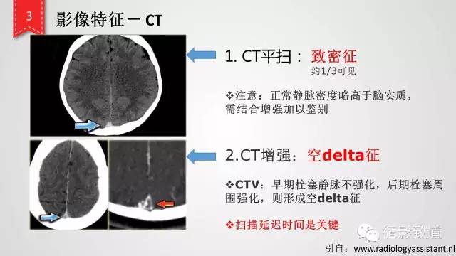 【病例】颅内静脉窦血栓形成1例CT及MR影像表现