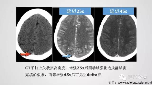 【病例】颅内静脉窦血栓形成1例CT及MR影像表现