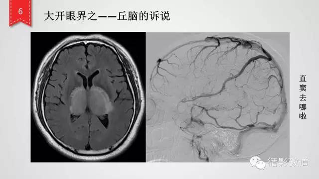 【病例】颅内静脉窦血栓形成1例CT及MR影像表现