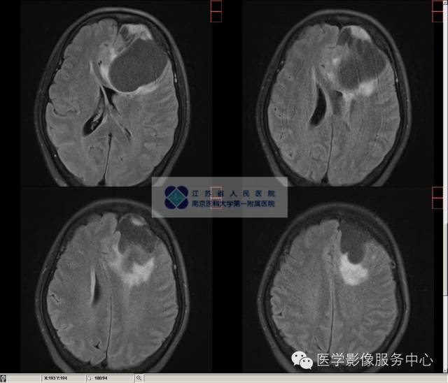 【病例】囊性脑膜瘤1例MR影像表现 【病例】囊性脑膜瘤1例MR影像表现