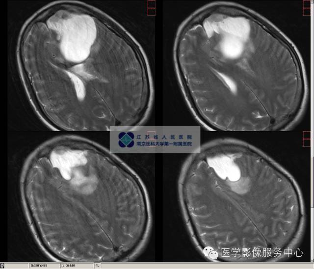 【病例】囊性脑膜瘤1例MR影像表现