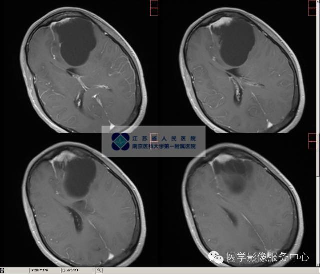 【病例】囊性脑膜瘤1例MR影像表现 【病例】囊性脑膜瘤1例MR影像表现