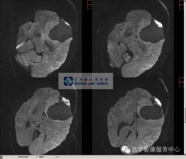 【病例】囊性脑膜瘤1例MR影像表现 【病例】囊性脑膜瘤1例MR影像表现