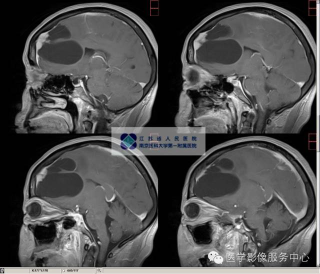 【病例】囊性脑膜瘤1例MR影像表现 【病例】囊性脑膜瘤1例MR影像表现