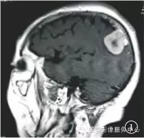 【病例】囊性脑膜瘤1例MR影像表现 【病例】囊性脑膜瘤1例MR影像表现
