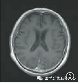 【病例】囊性脑膜瘤1例MR影像表现 【病例】囊性脑膜瘤1例MR影像表现