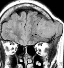 颅骨常见疾病的鉴别诊断