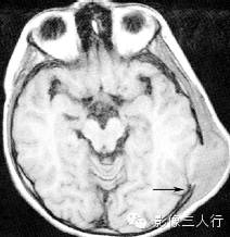 颅骨常见疾病的鉴别诊断