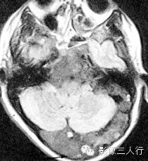 颅骨常见疾病的鉴别诊断