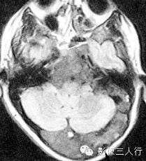 颅骨常见疾病的鉴别诊断