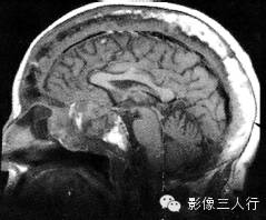 颅骨常见疾病的鉴别诊断