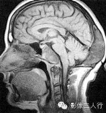 颅骨常见疾病的鉴别诊断