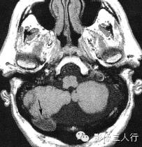 颅骨常见疾病的鉴别诊断