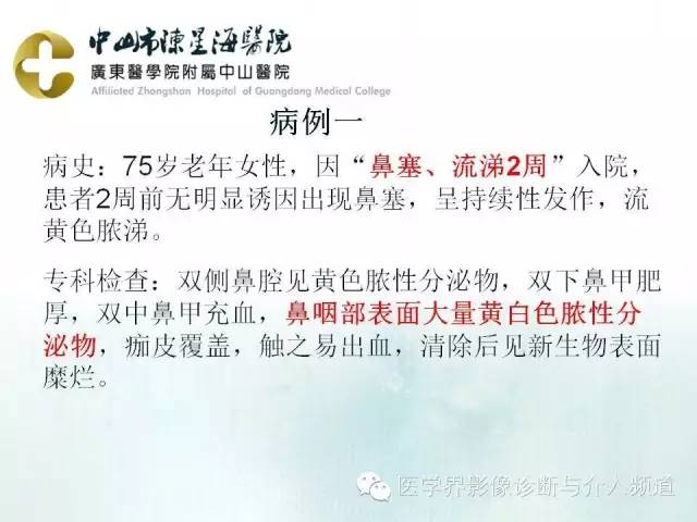结外NK/T细胞淋巴瘤