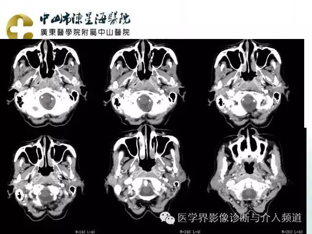 结外NK/T细胞淋巴瘤