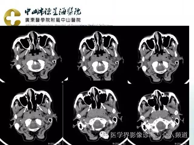 结外NK/T细胞淋巴瘤