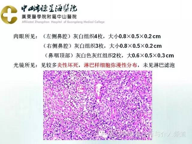结外NK/T细胞淋巴瘤