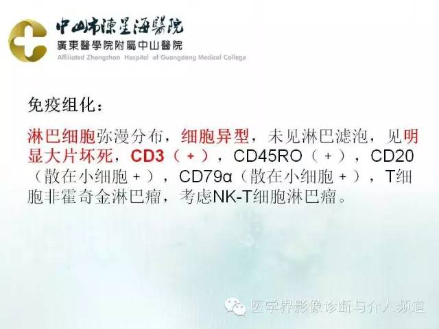 结外NK/T细胞淋巴瘤