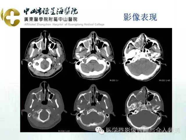结外NK/T细胞淋巴瘤
