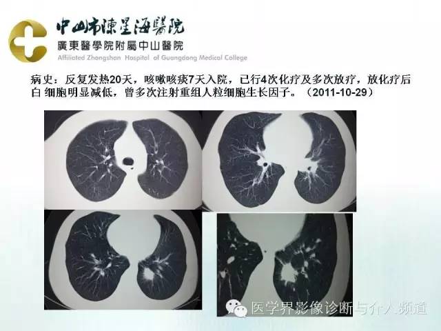 结外NK/T细胞淋巴瘤