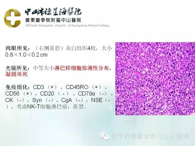 结外NK/T细胞淋巴瘤