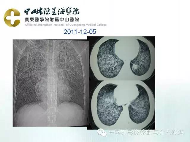 结外NK/T细胞淋巴瘤