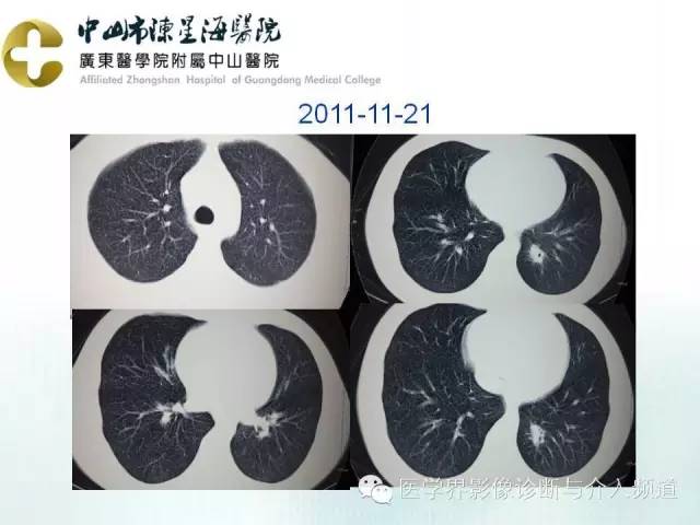 结外NK/T细胞淋巴瘤