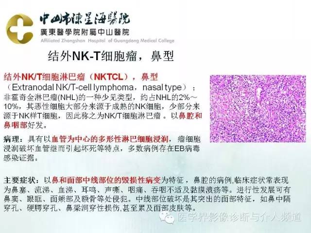 结外NK/T细胞淋巴瘤