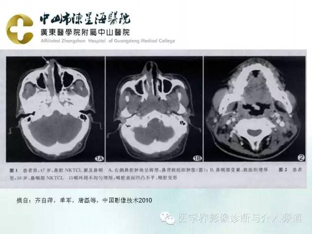 结外NK/T细胞淋巴瘤