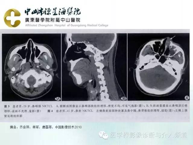结外NK/T细胞淋巴瘤