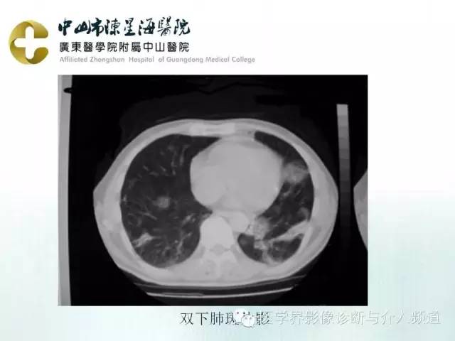 结外NK/T细胞淋巴瘤