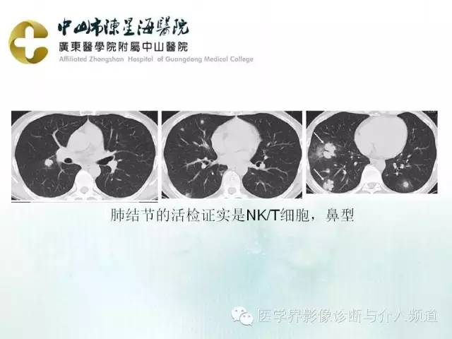 结外NK/T细胞淋巴瘤