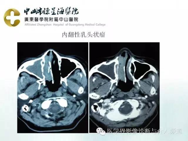 结外NK/T细胞淋巴瘤